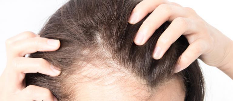 女性の薄毛を引き起こす原因と対策【7選】 mlife