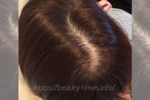 女性の自毛植毛体験ブログ（1）手術準備と後頭部の刈り上げ_施術前