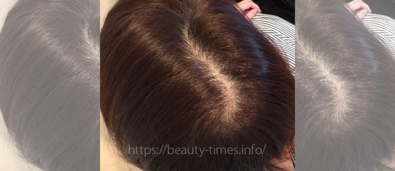 女性の自毛植毛体験ブログ（1）手術準備と後頭部の刈り上げ_施術前