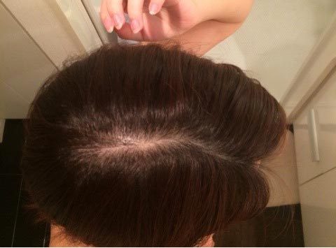 薄毛に悩むアラサー女が自毛植毛した話（6）【手術2週間後】_女性の薄毛改善
