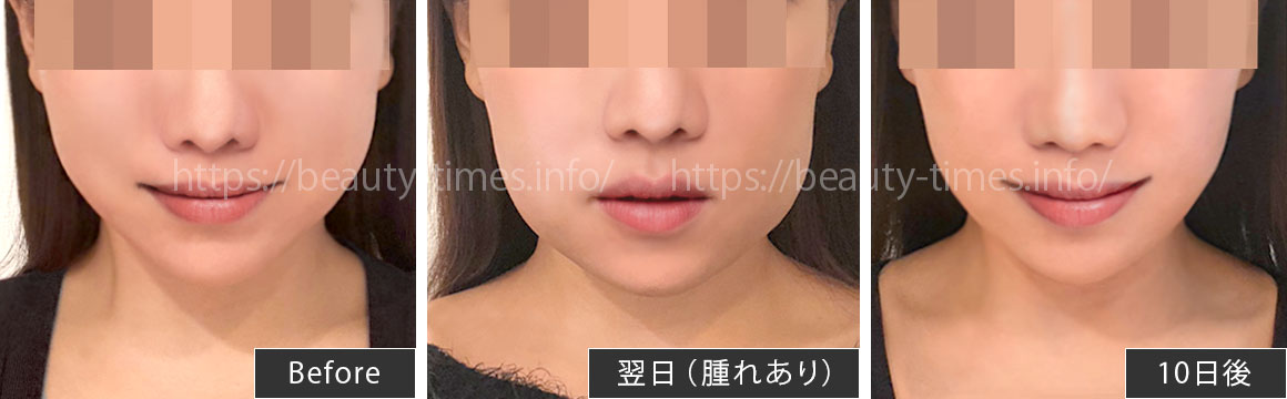 カベリン(脂肪溶解注射)の経過【体験レポ】