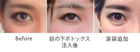 【まさかの失敗】目の下のボトックス注射の失敗談と対処法