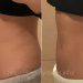 クールスカルプティング®(ボディコントゥアリング治療)の効果&体験談【ビフォーアフター症例写真】